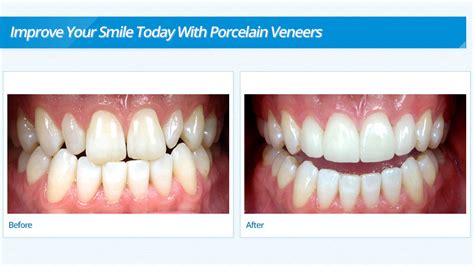 porcelain veneers burnsville mn|Dentists in Burnsville, MN. .